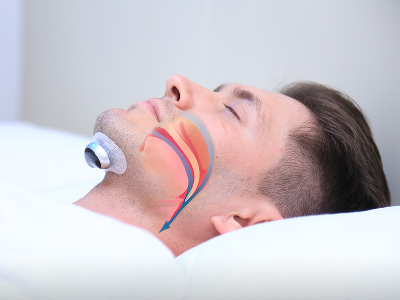 SleepGuard 2.0 - Zeg Vaarwel tegen Snurken - Innovatief Anti Snurk Apparaat