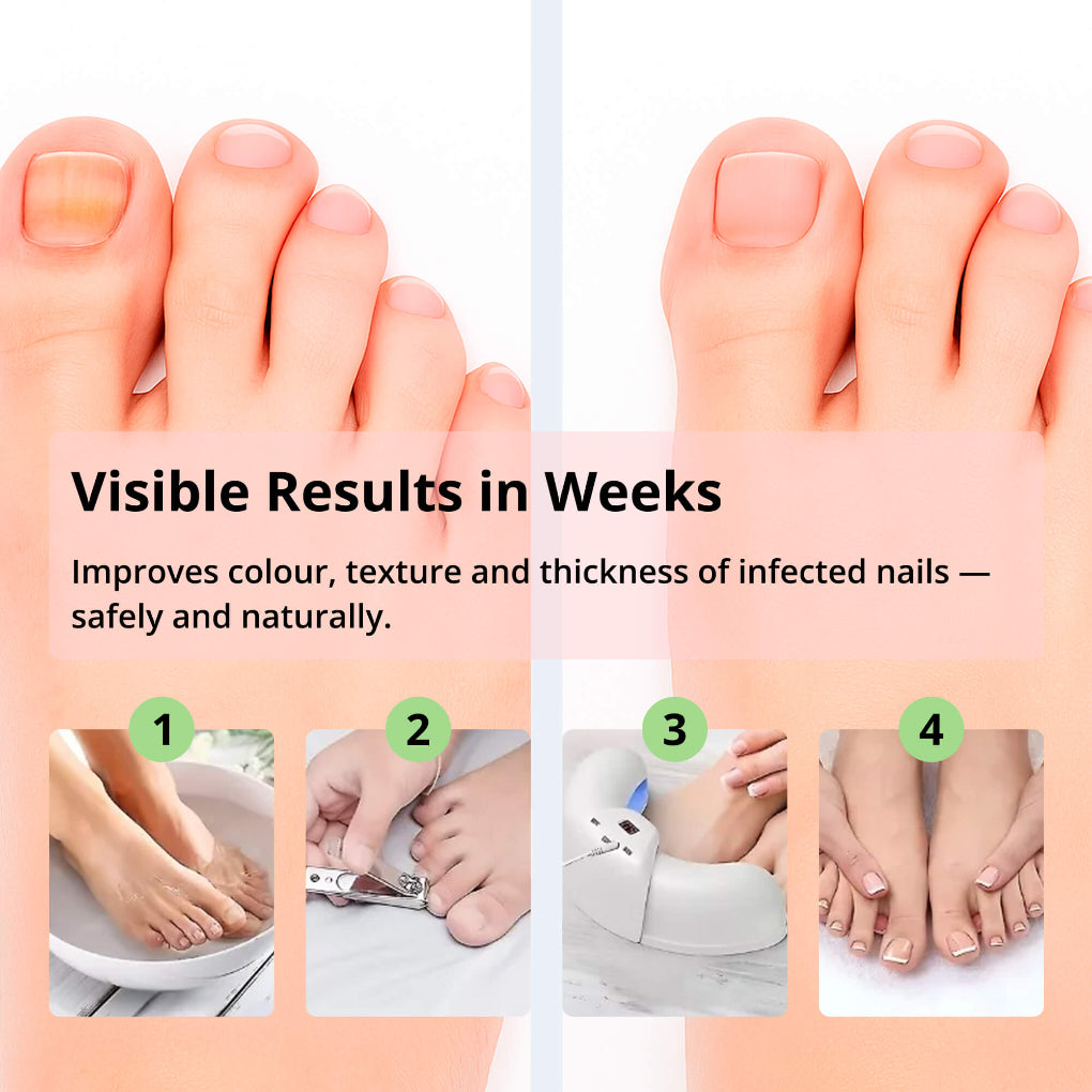 Laserapparaat voor het verwijderen van nagelschimmel