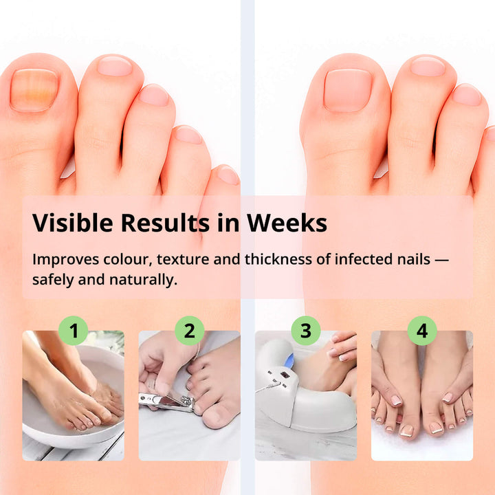 Laserapparaat voor het verwijderen van nagelschimmel