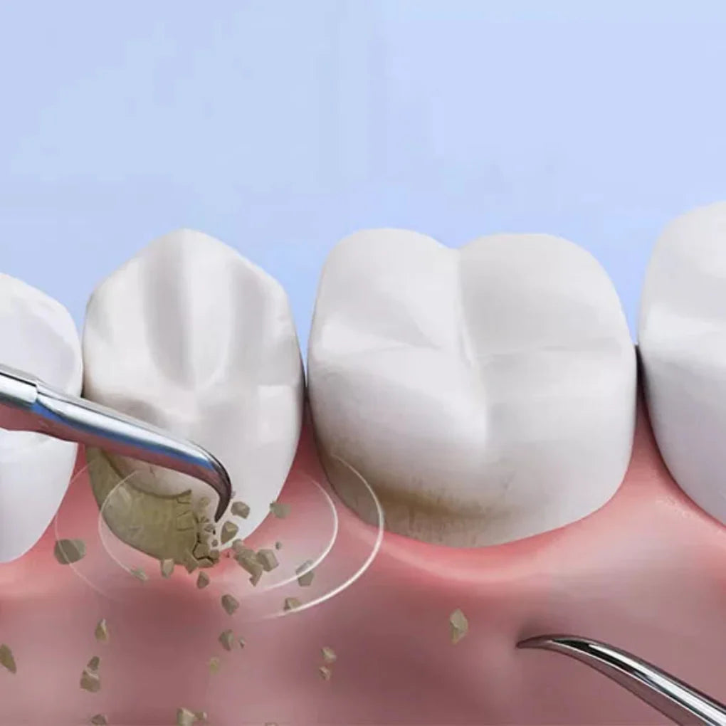 Tandsteenverwijderingstool