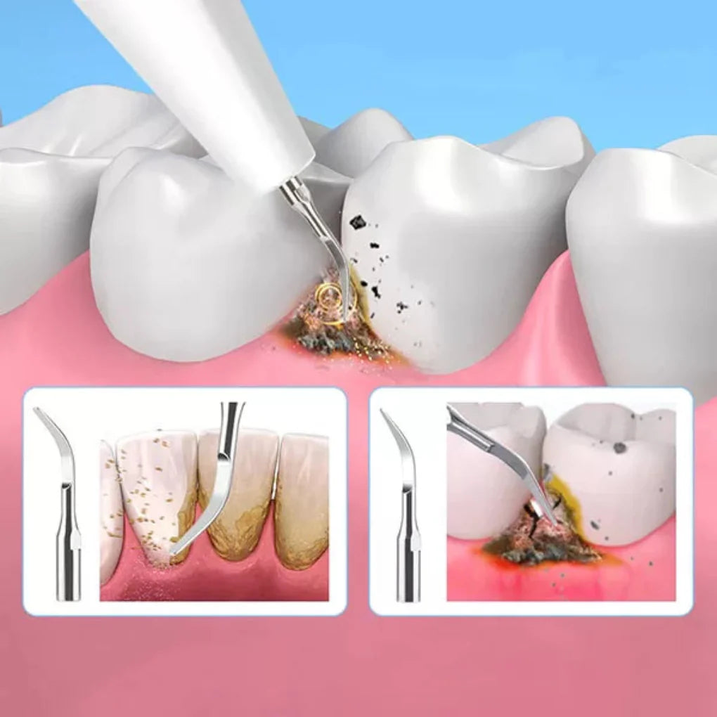 Tandsteenverwijderingstool
